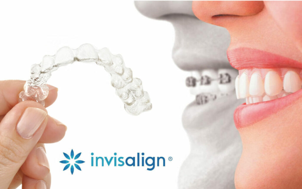 brackets invisibles - Invisalign OKC