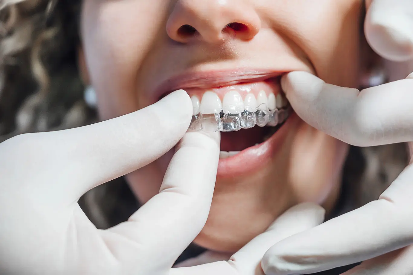 Invisalign is a great option for straightening teeth before a wedding because the tray can be removed for events.